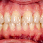 Front-tooth-Fillings-150x150