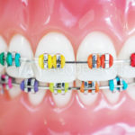 Tooth-Colour-Braces-treatment-150x150