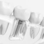 dental-implant-150x150